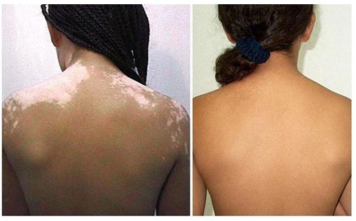 Vitiligo, tratamiento con Melagenina Plus, repigmentación despues de un año